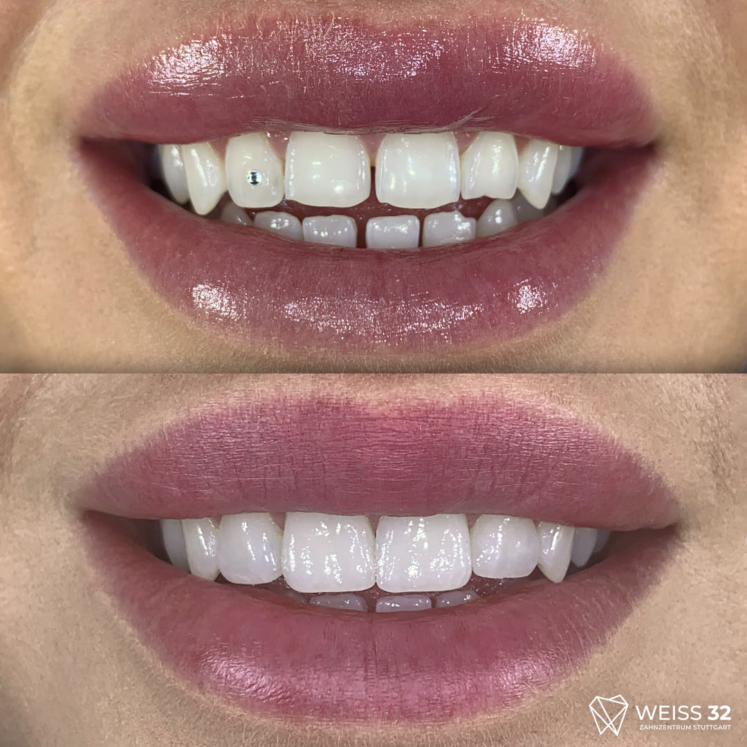 veneers 6