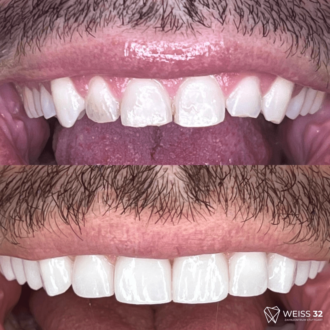 veneers 6