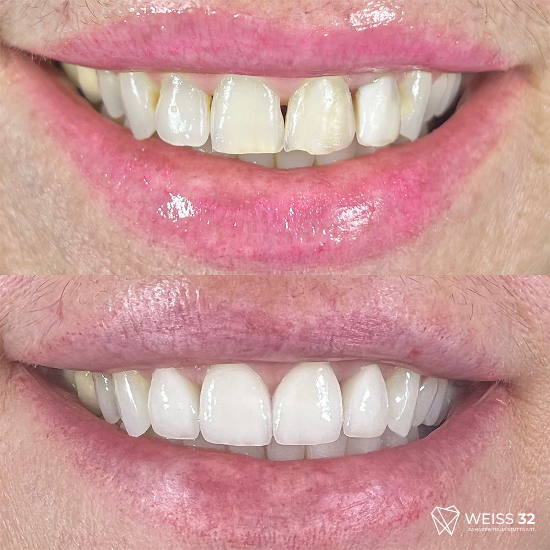 veneers 7