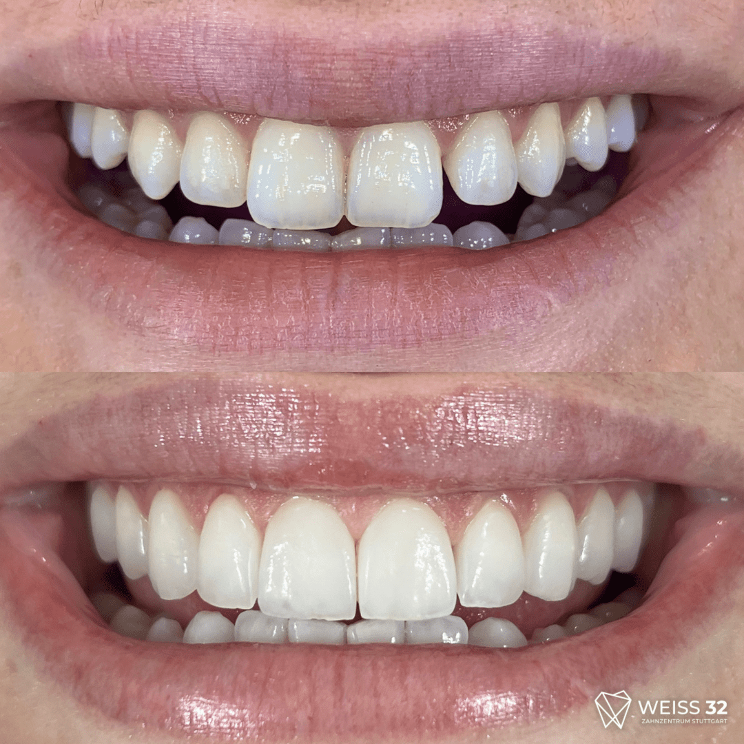 veneers
