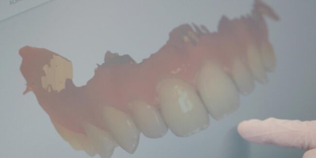 Fotosimulation Sehen, wie Ihr Lächeln aussehen wird, noch bevor die Behandlung beginnt! blog Fotosimulation: Sehen, wie Ihr Lächeln aussehen wird, noch bevor die Behandlung beginnt! Zahnarzt Stuttgart WEISS32