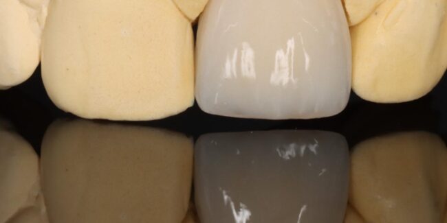 Zahnkrone Kosten Materialien Preise WEISS32 Zahnkrone Kosten – Materialien und Preise bei WEISS32 Stuttgart