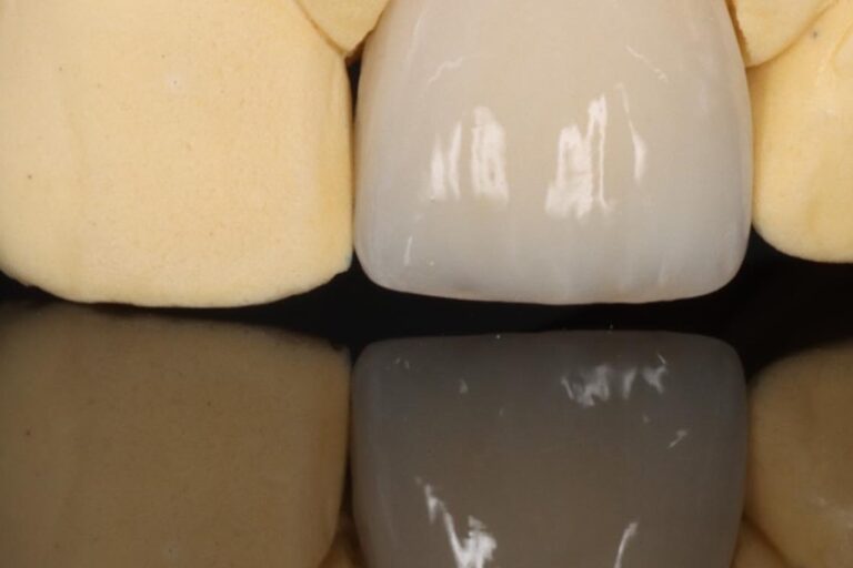 Zahnkrone Kosten Materialien Preise WEISS32 Zahnkrone Kosten – Materialien und Preise bei WEISS32 Stuttgart