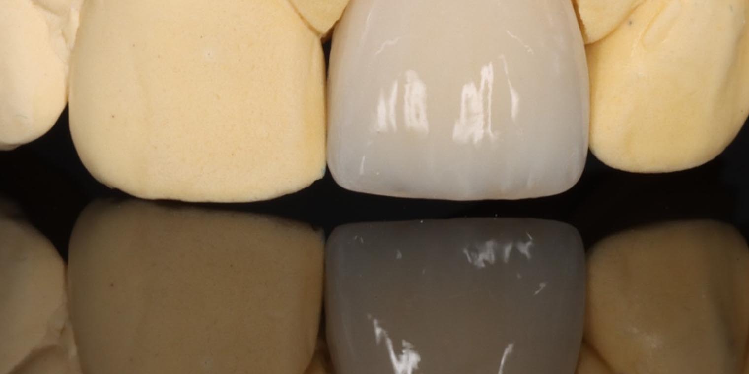 Zahnkrone Kosten – Materialien und Preise bei WEISS32 Stuttgart