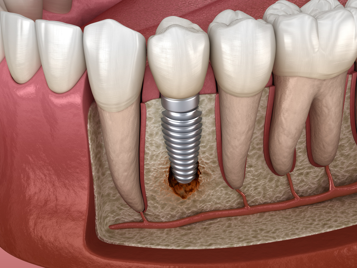 Periimplantitis with visible bone damage. Medically accurate 3D illustration of dental implants concept
