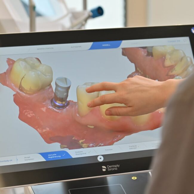 weiss32 photo Praxiseigenes Labor Blog Implantate oder Brücke – Zahnersatz-Vergleich WEISS32 Stuttgart