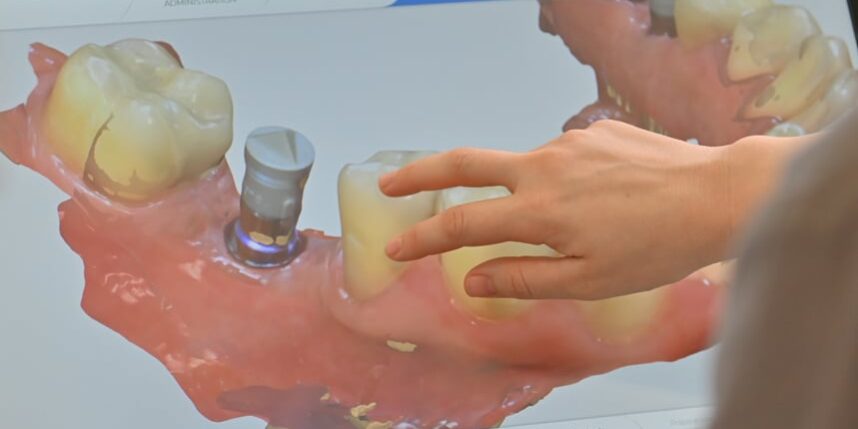 Implantate oder Brücke – Zahnersatz-Vergleich WEISS32 Stuttgart